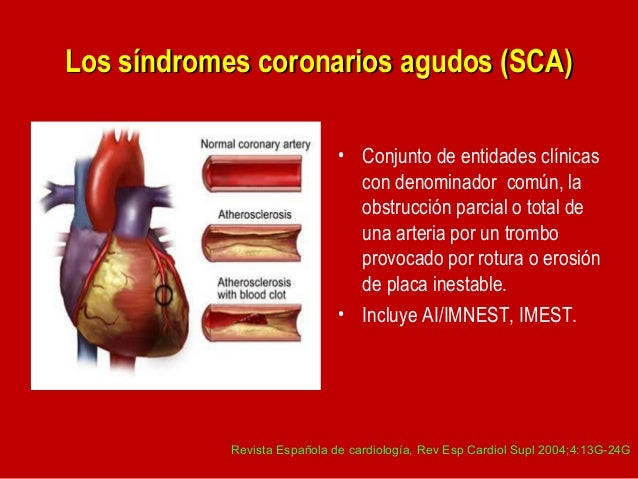 Sindromes Coronarios Agudos Epub